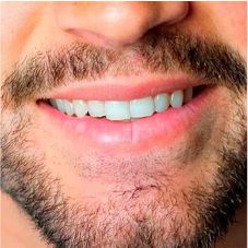 blanqueamiento-dental-cali-precios