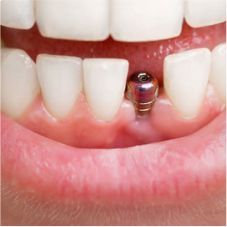 implantes-cali-precios