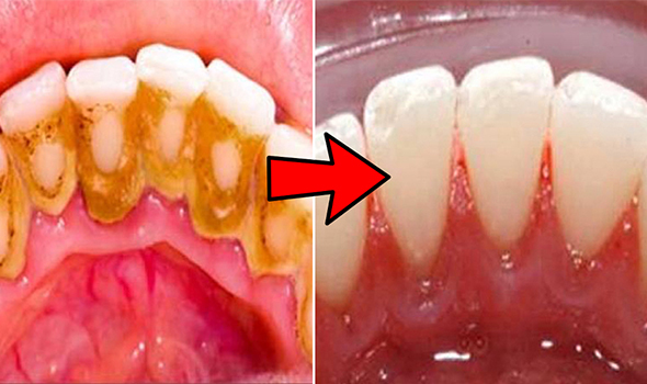 calculos-dentales-limpieza-dental-profunda