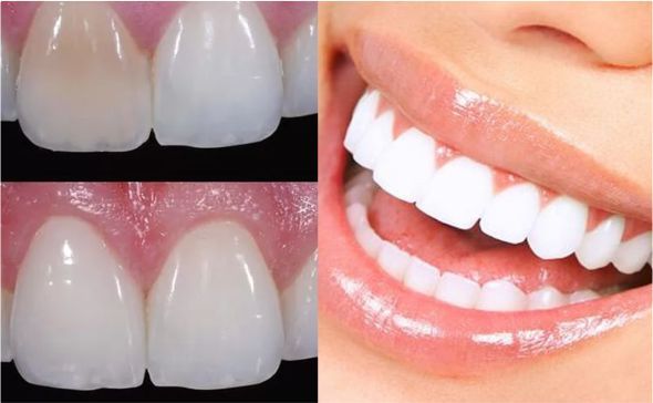 blanqueamiento-dental-interno
