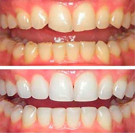 diseño de sonrisa-dientes bordes desgastados