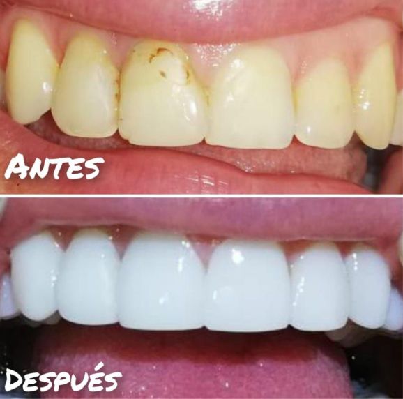 diseño de sonrisa-dientes manchados-amarillos