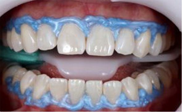 blanqueamiento-dental-cali