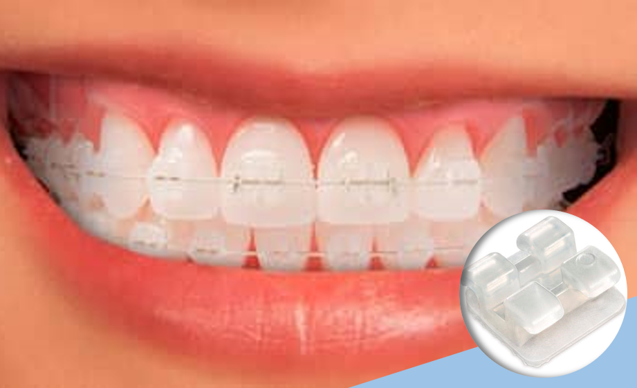 brackets-esteticos