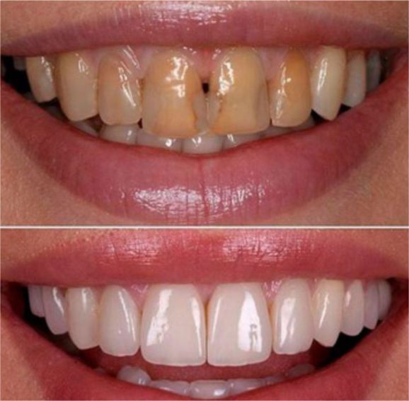 diseño de sonrisa-cali-precios