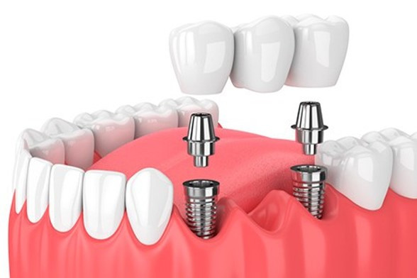 protesis-fija-sobre-implantes