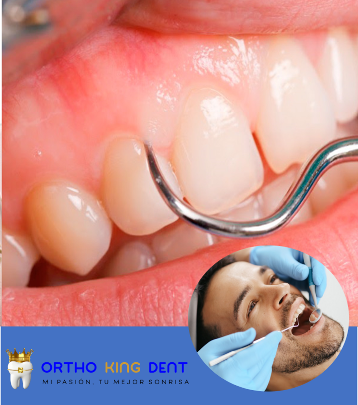 blanqueamiento-dental-interno