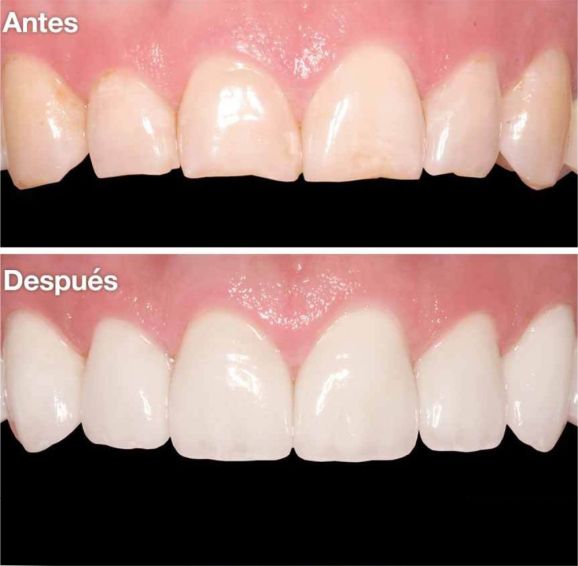 diseño de sonrisa-dientes partidos