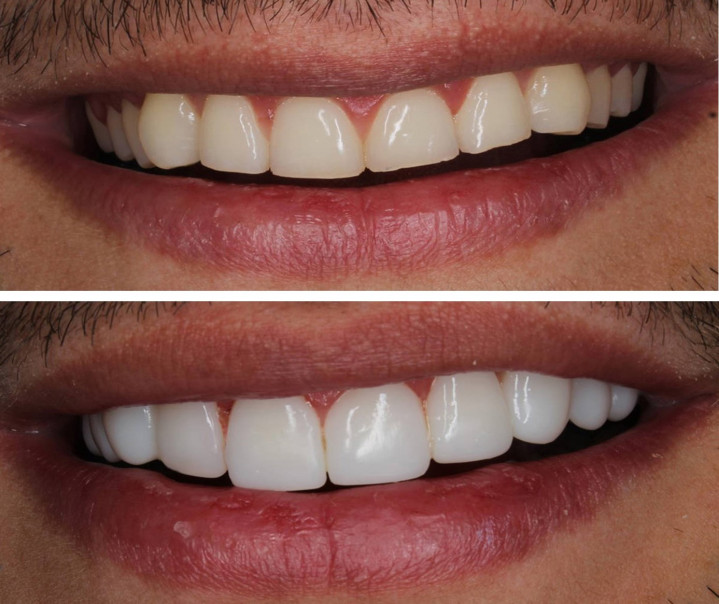 diseño-sonrisa-carillas-resina-cali