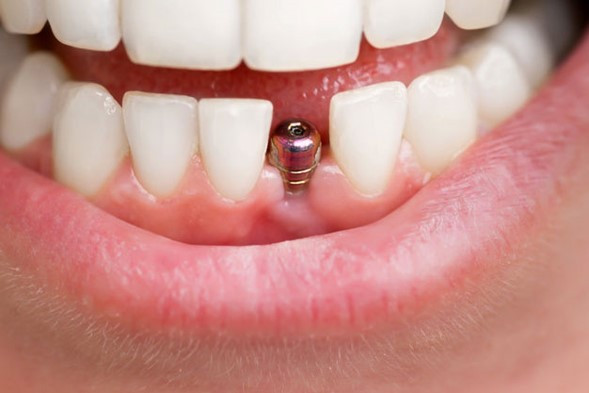 implante-dental