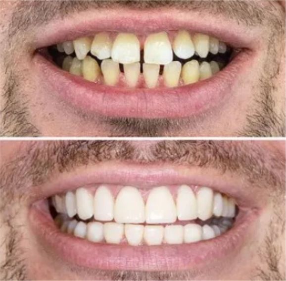 diseño de sonrisa-dientes con espacios